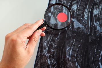 Nowotwory kregoslupa i kanalu kregowego Nowotwory kregoslupa i kanalu kregowego