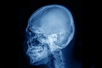 Patologie zlacza szczytowo-potylicznego Patologie zlacza szczytowo-potylicznego