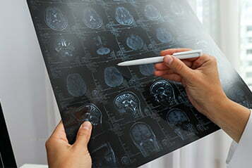 Zespol Chiari'ego Zespol Chiari'ego